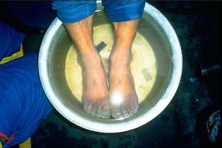 Mottling Of Feet